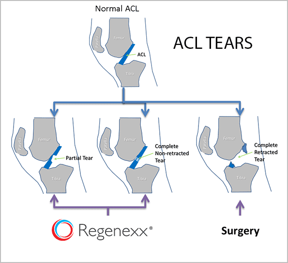 Regenexx procedures are focused on treating full and partial tears that are non-retracted.